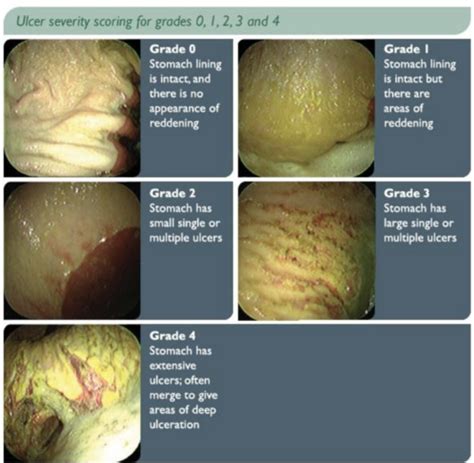 Disorders Of The Esophagus And Stomach Flashcards Quizlet