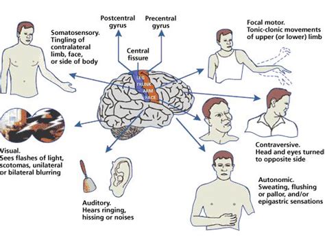 Generalized Tonic Clonic Epilepsy Seizures Grand Mal Seizures