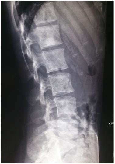 X Ray Shows Multiple Well Defined Sclerotic Lesions Without Bone