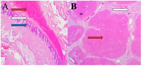 Hepatocutaneous Syndromesuperficial Necrolytic Dermatitis Snd In