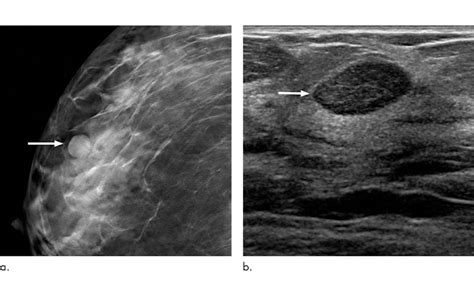 Mammogram Showing Cyst