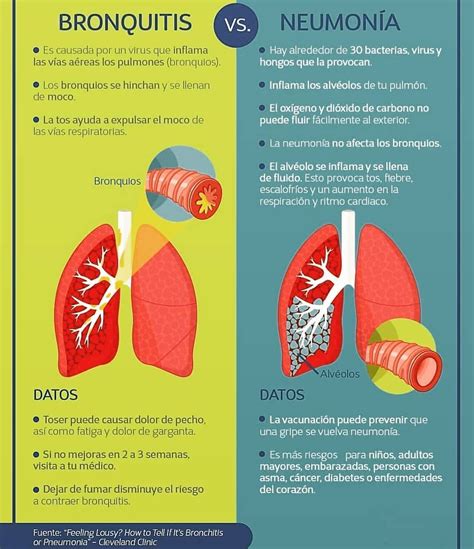 Bronquitis VS Neumonía La Bronquitis es causada por un virus que