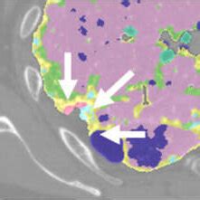 Images Of A Year Old Man With Idiopathic Pulmonary Fibrosis A