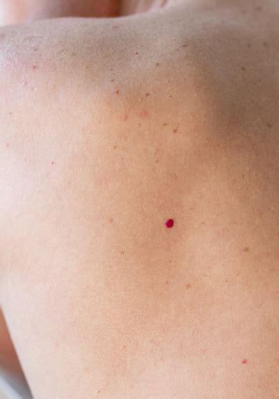 Cherry Angiomas – Laser and Skin Clinics