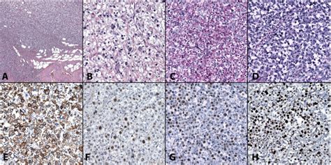 Hematoxylin And Eosin Staining Of The Cystectomy Specimen A Sheets