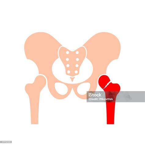 Hip Bone Fracture Stock Illustration - Download Image Now - Anatomy ...