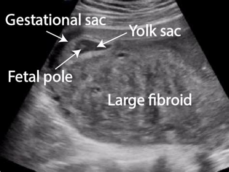 Very Large Uterine Fibroid In Patient With An Early Intrauterine Pregnancy Critical Care