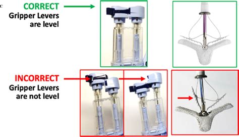 Transcatheter Edge To Edge Mitral Valve Repair Mitraclip Step By Step