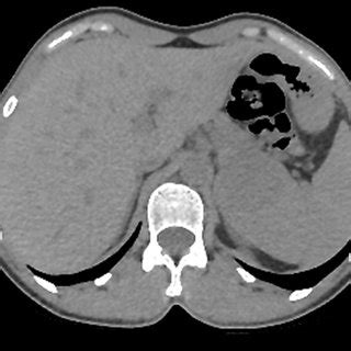 Ct Scan Of The Abdomen Showing An Iso Dense Mass Of The Upper Pole Of