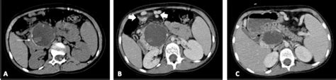 Figure 1 From Cystic Teratoma Of The Pancreas Semantic Scholar