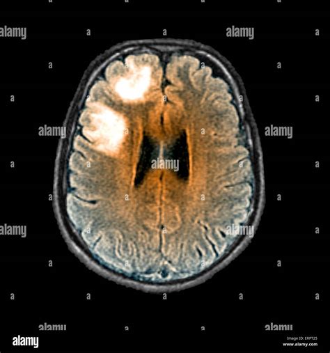 Histolog A De La Leucoencefalopat A Multifocal Progresiva