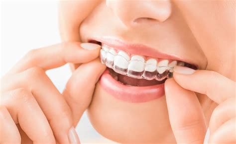 Invisalign Warszawa Cena Kurka