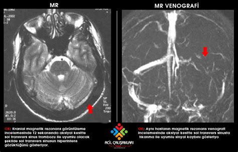 Serebral Ven Trombozu Acil Çalışanları