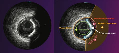 Intra Vascular UltraSound IVUS Study SozoCardiology Dr Ooi Yau