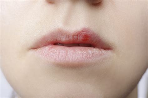 ¿qué Es El Herpes Labial Y Cómo Tratarlo Clínica Dental Villalaín