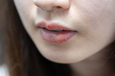 Di Bibir Ada Luka Melepuh Awas Bisa Jadi Karena Herpes Simplex