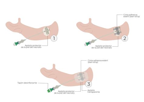 Canalizaci N Y Fijaci N De Las L Neas Medias En Neonatos Campus Vygon