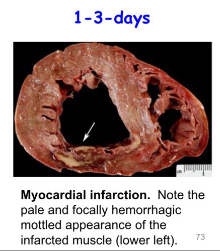 Pathology Ischemic Heart Disease Ii Flashcards Quizlet