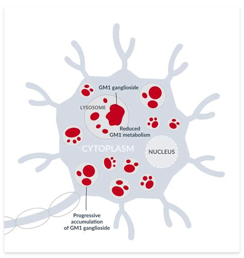 Passage Bio, Inc. - Patients and Caregivers - GM1 Gangliosidosis