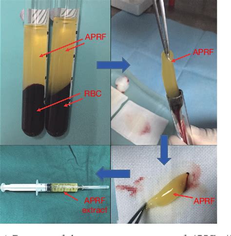 Figure 1 From Advanced Platelet Rich Fibrin Promotes The Paracrine