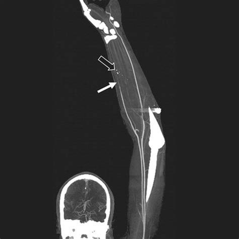 Ct Angio Venous Upper Limb Test Price In Delhi Ganesh Diagnostic