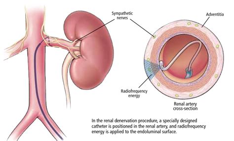 Renal Denervation Therapy In Singapore The Heart Practice Clinic