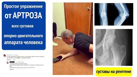 Артроз, который "не лечится" - это проблема. Но мастер лег на живот ...