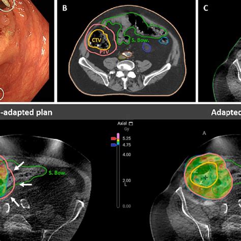 A Six Radio Opaque Markers Were Inserted Endoscopically In The Normal