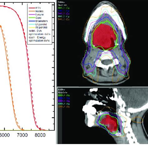 Comparison Of Dose Volume Histograms Dvhs And Isodoses For A Single