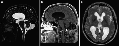 A C Preoperative Sagittal A And Axial C T2 Weighted And