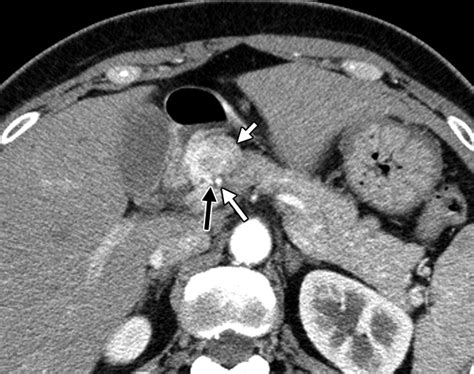 Ct Characterization Of Duodenal Gastrointestinal Stromal Tumors Ajr