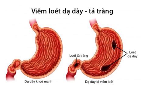 Chữa viêm loét dạ dày tá tràng theo phác đồ của bộ Y tế TCI Hospital