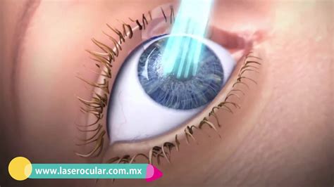 🥇 Cirugía Láser Excímer LÁser Ocular ® Clínica De Ojos Youtube