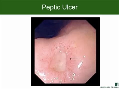 Clinical Case 4 Dyspepsia And Peptic Ulcer Flashcards Quizlet