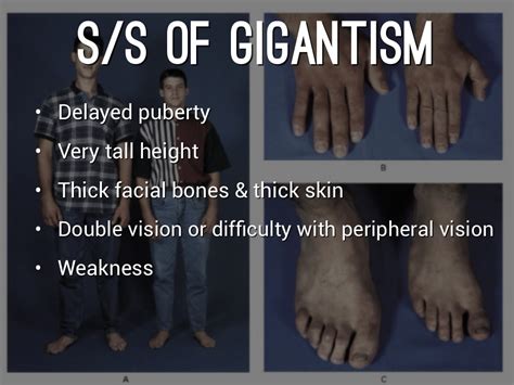 Gigantism By Sabra Cowart