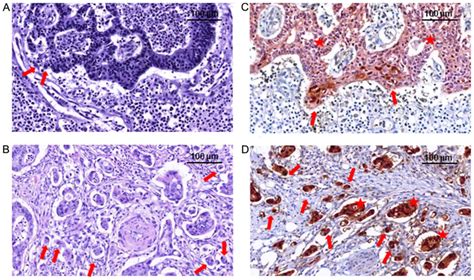 Immunohistochemical‑based Molecular Subtyping Of Colorectal Carcinoma Using Maspin And Markers