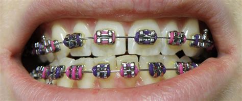 Purple And Pink Braces Dental Braces Teeth Braces Ceramic Braces