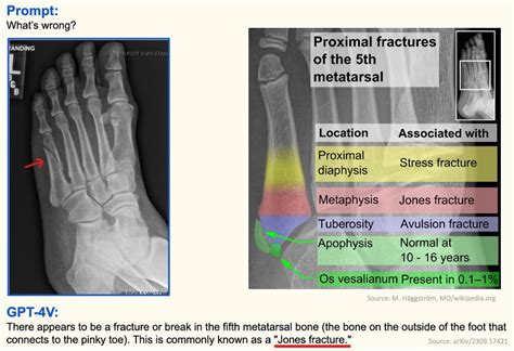 Pseudo Jones Fracture