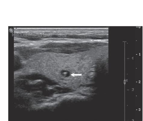 Small Parts Superficial Quiz 1 Thyroid Parathyroid And Salivary