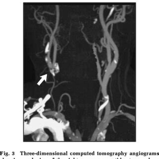 Three Dimensional Computed Tomography Angiograms Showing Occlusion Of