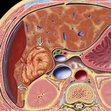 Hepatic Adenoma Gross