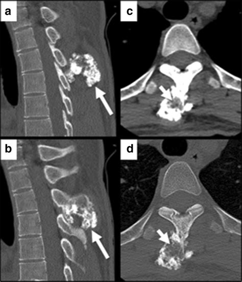 Sagittal Non Contrast Ct A B And Axial Ct C D Demonstrate A Download Scientific Diagram