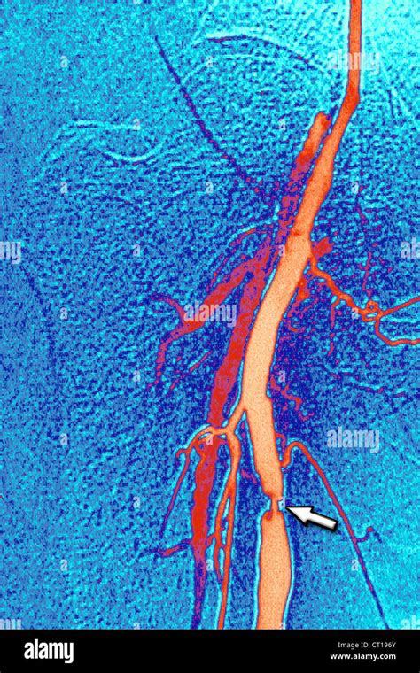 STENOSIS, FEMORAL ARTERY, ANGIO Stock Photo - Alamy