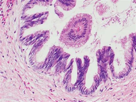 Surgical Specimen Case 1 × 20 Gastric Type Intraductal Papillary