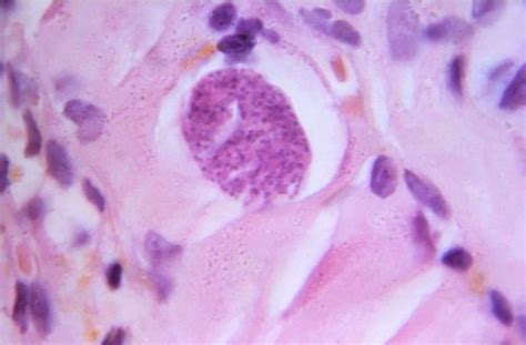 Toxoplasma Gondii Brain Abscess