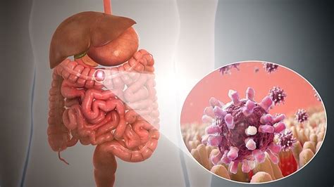 Sintomas De Gastroenteritis