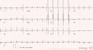 Dextrocardia & It's ECG Interpretation: A Complete Guide