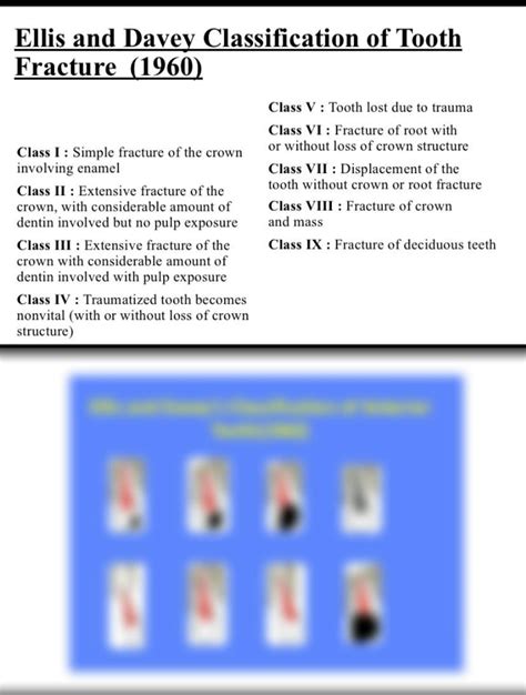 Solution Ellis Classification Of Fracture For Anterior Tooth Studypool