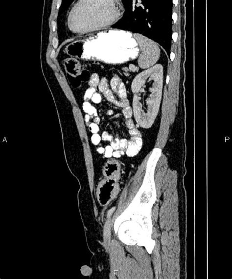 Ulcerative Colitis Image Radiopaedia Org