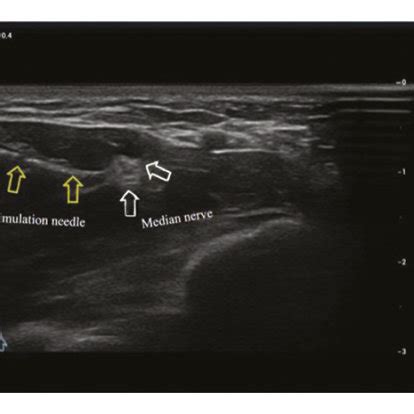 Median Nerve Electrical Stimulation Under Ultrasound A Median Nerve